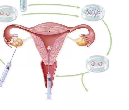 没有卵泡去福建医科大学第一附属医院做三代试管贵吗？费用明细是怎么样的？